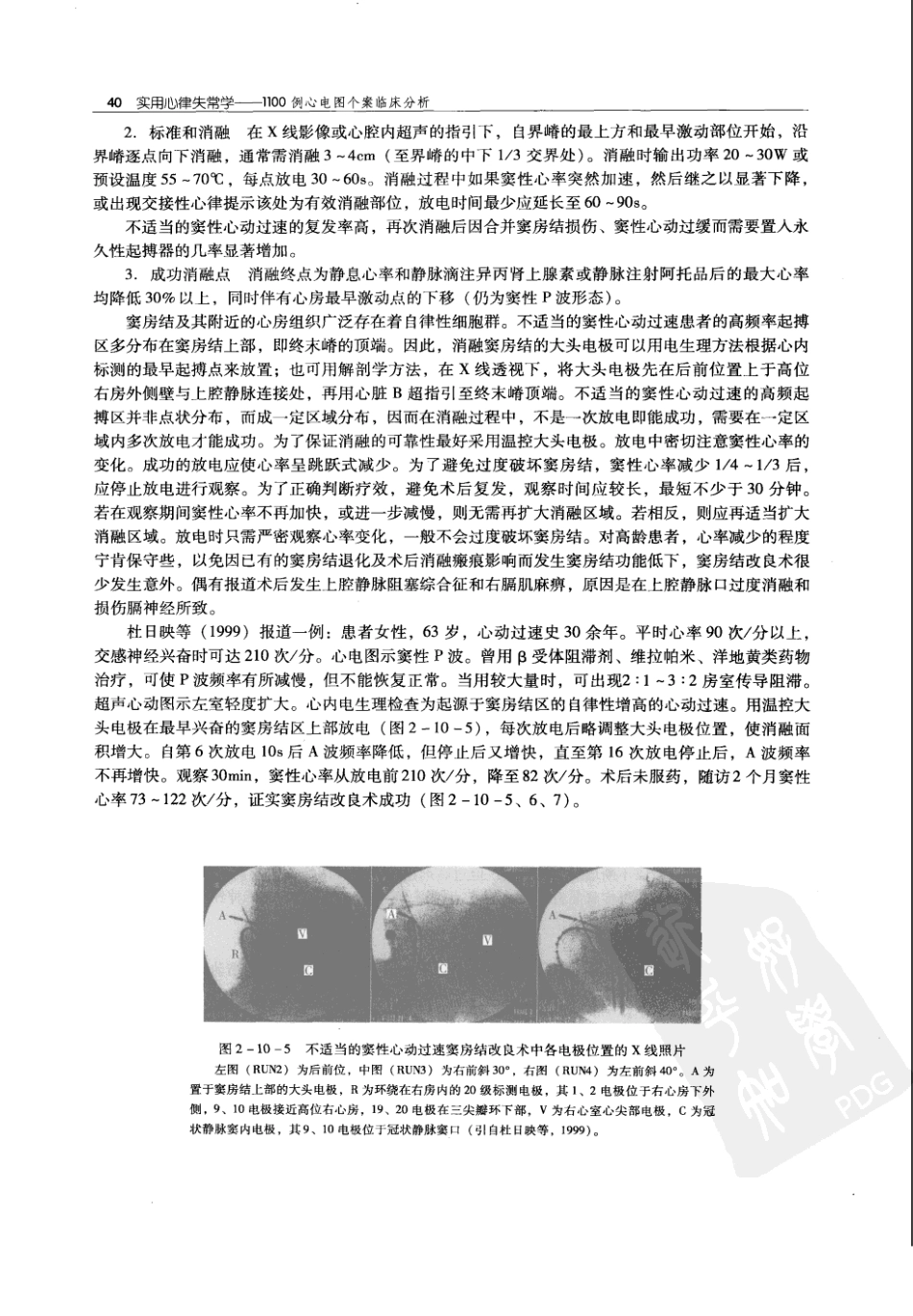 实用心律失常学：1100例心电图个案临床分析  第2版_中国协和医科大学出版社_2008.10_夏宏器，邓开伯主编_51-100.pdf_第2页