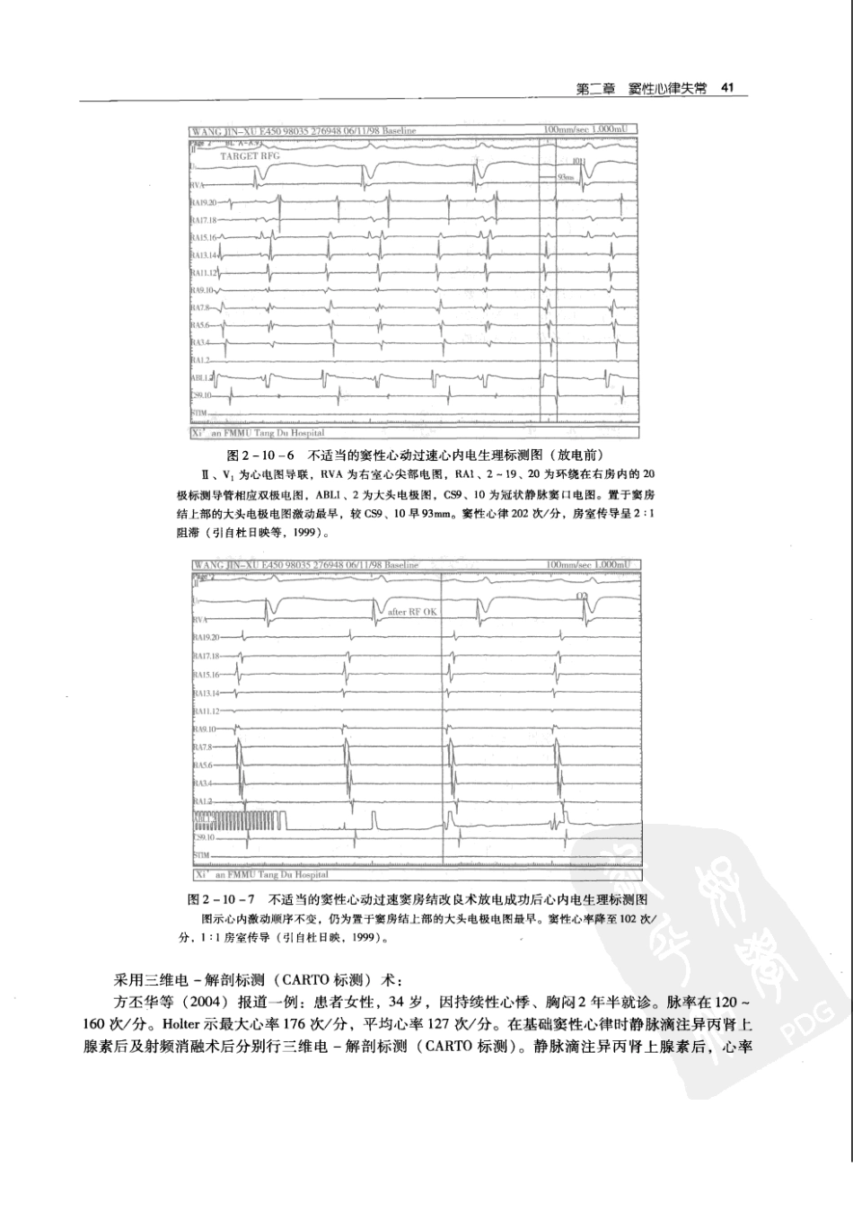 实用心律失常学：1100例心电图个案临床分析  第2版_中国协和医科大学出版社_2008.10_夏宏器，邓开伯主编_51-100.pdf_第3页