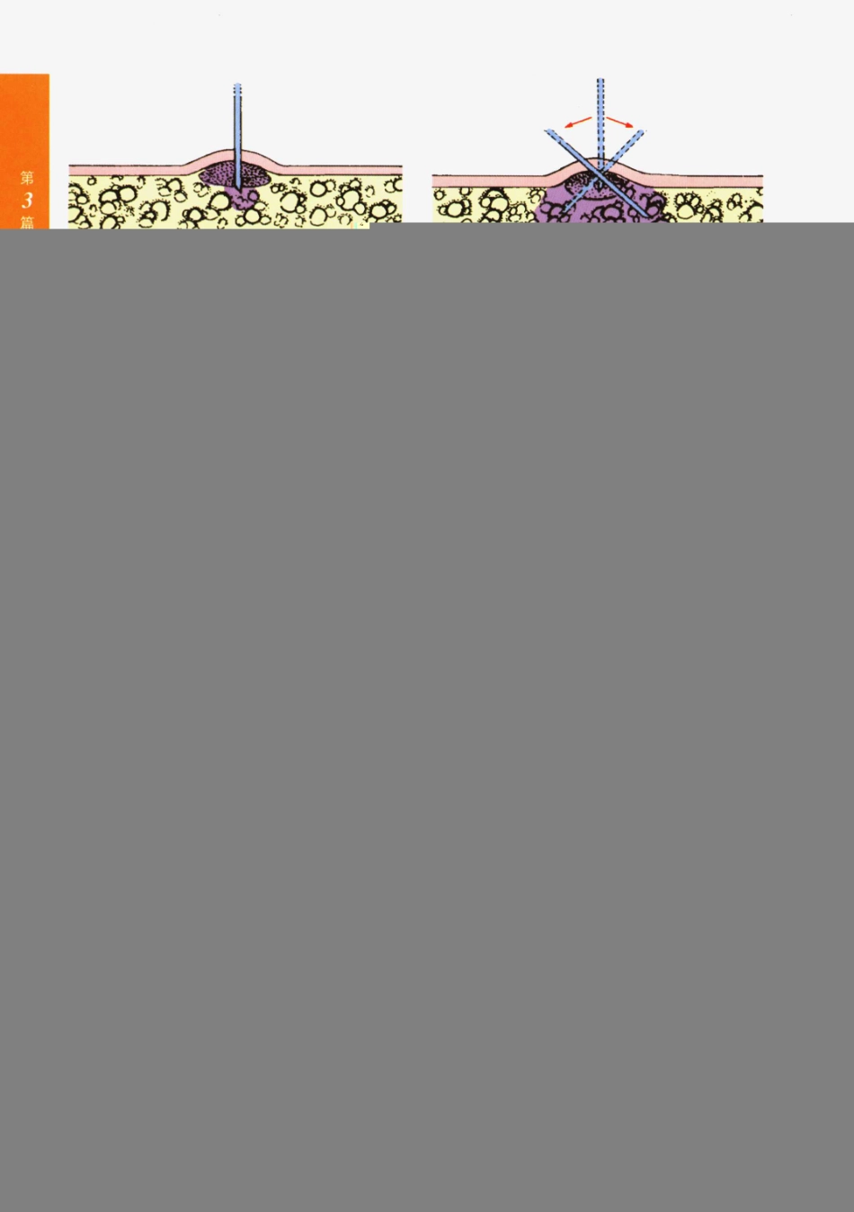 临床局部麻醉技术_551-575.pdf_第3页