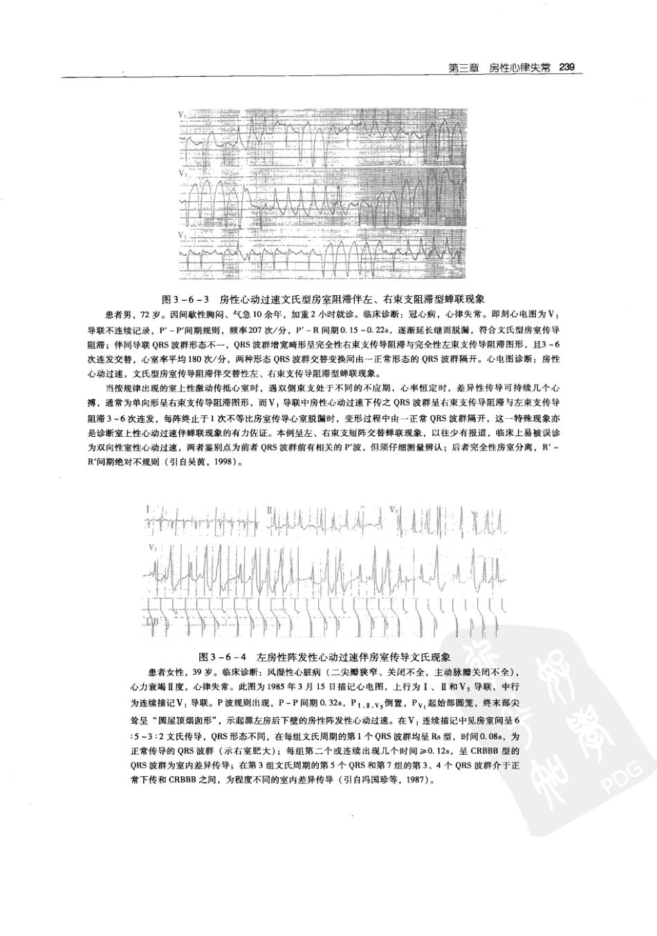 实用心律失常学：1100例心电图个案临床分析  第2版_中国协和医科大学出版社_2008.10_夏宏器，邓开伯主编_251-300.pdf_第1页
