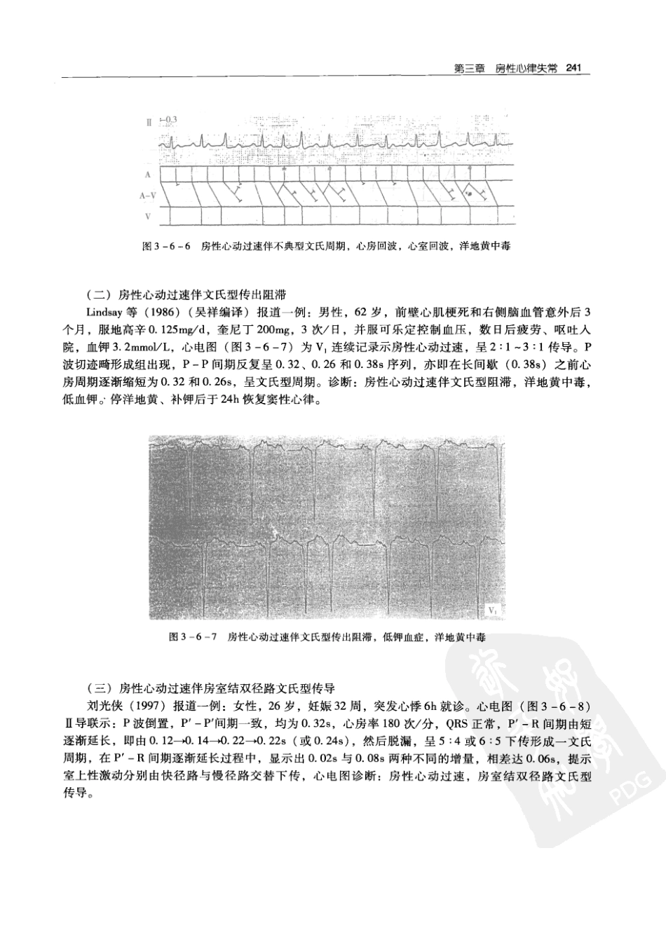 实用心律失常学：1100例心电图个案临床分析  第2版_中国协和医科大学出版社_2008.10_夏宏器，邓开伯主编_251-300.pdf_第3页