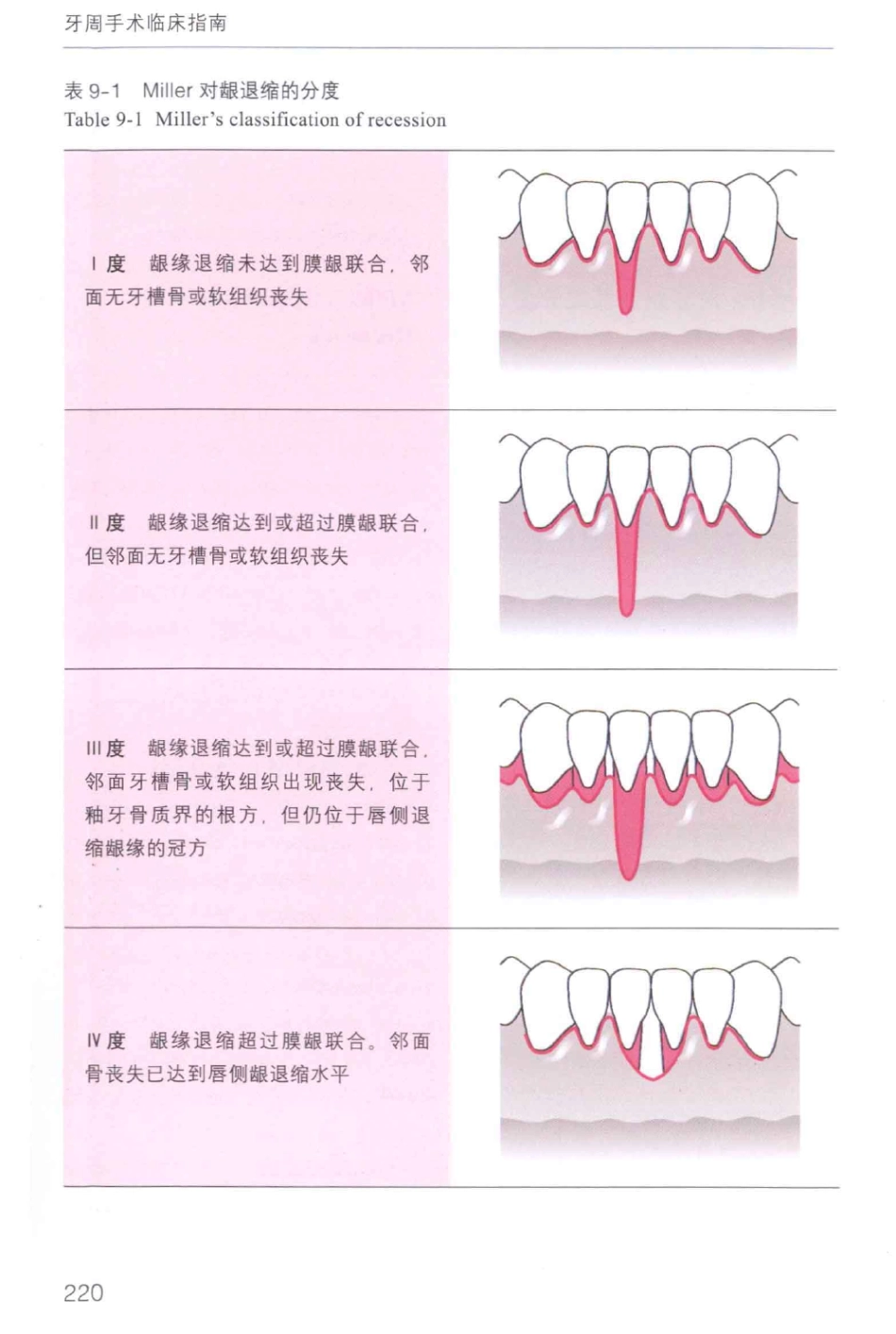 牙周手术临床指南 中英文对照_俞雪芬2013（彩图）_229-240.pdf_第2页