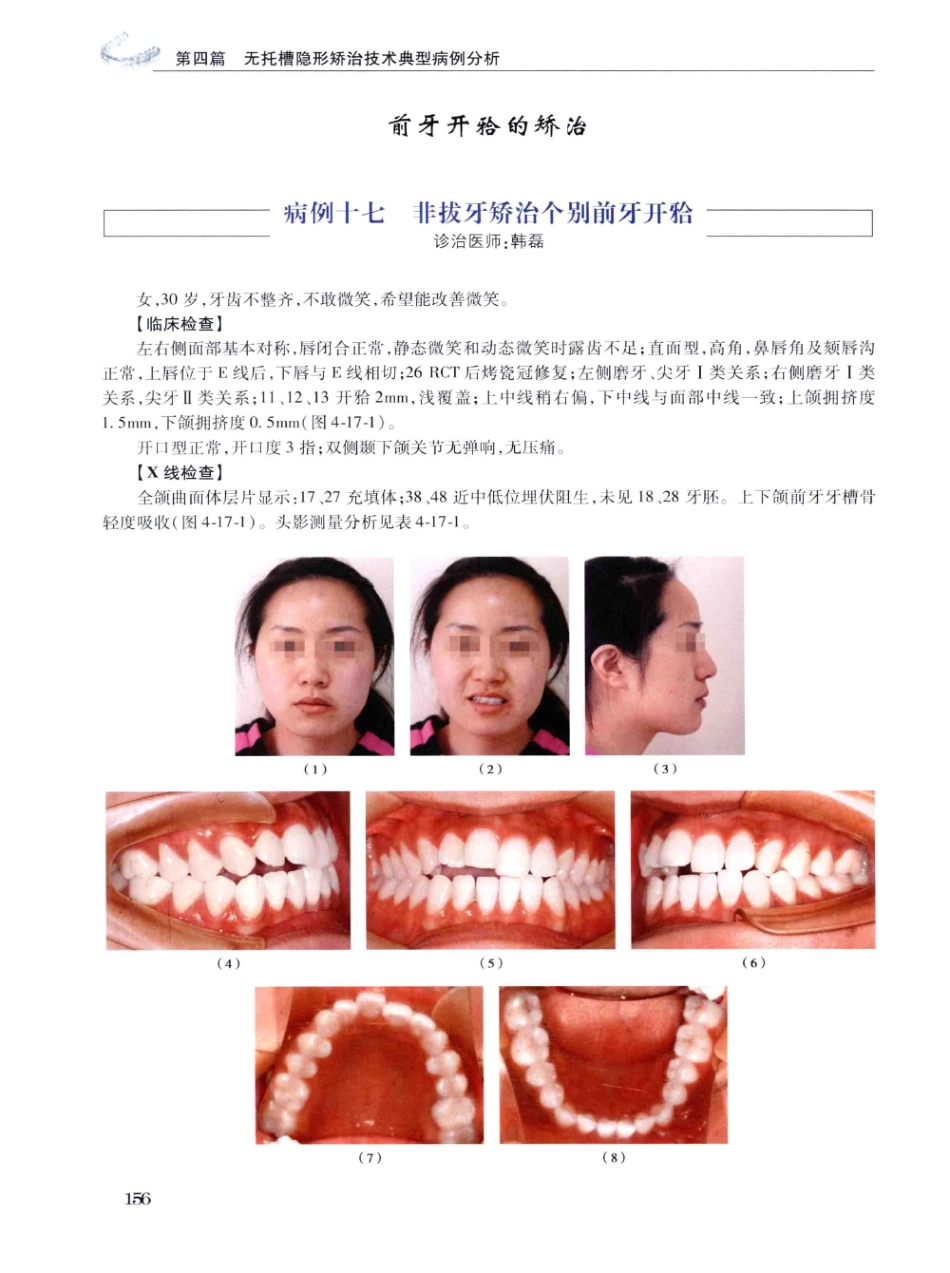 口腔正畸现代无托槽隐形矫治技术 田杰著 2014_169-180.pdf_第2页