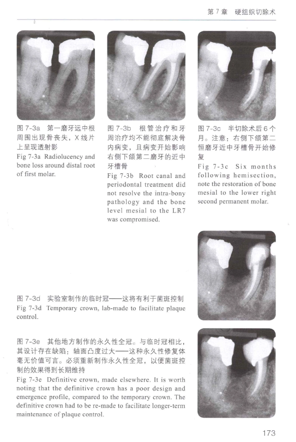 牙周手术临床指南 中英文对照_俞雪芬2013（彩图）_181-192.pdf_第3页