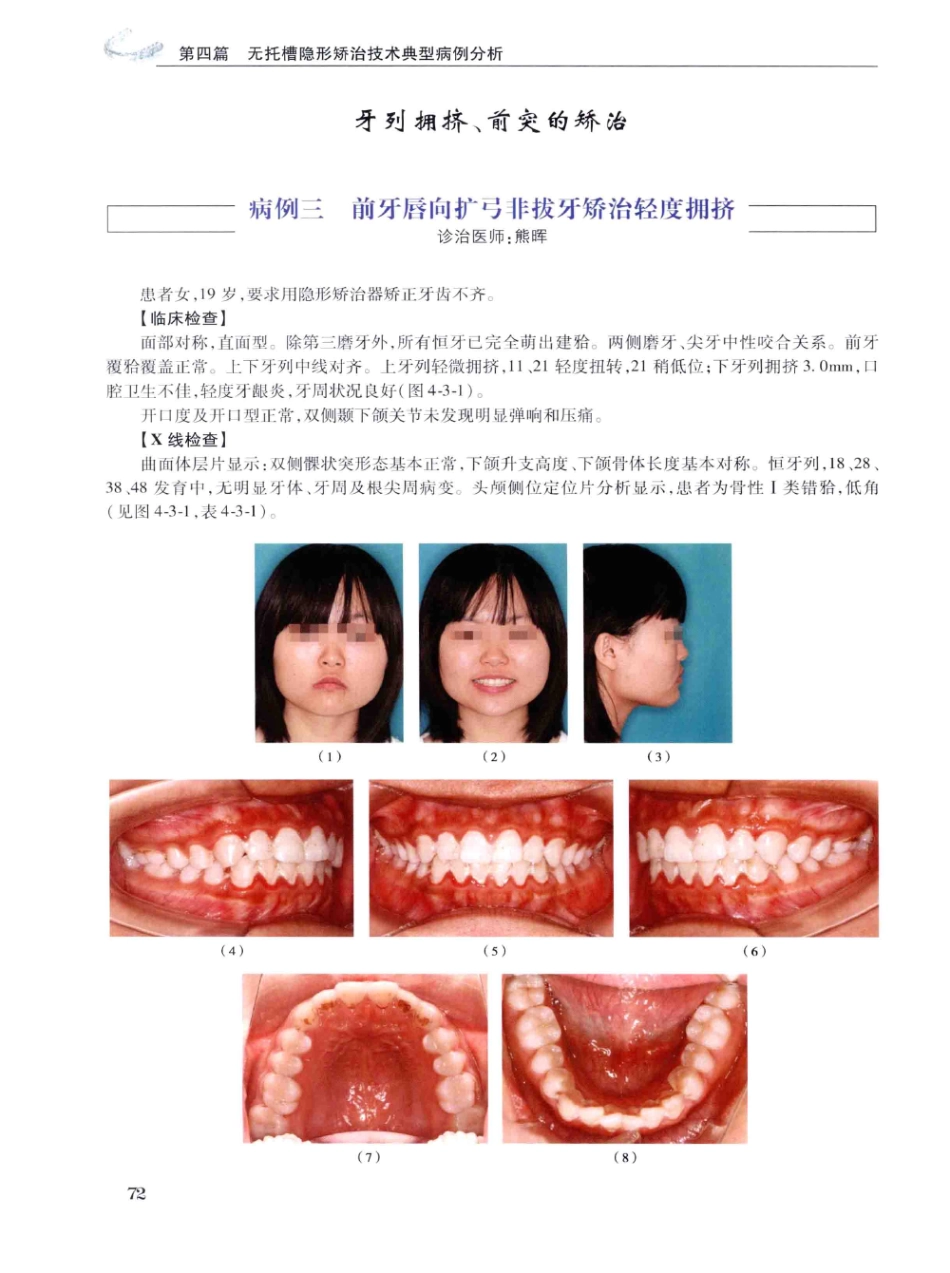 口腔正畸现代无托槽隐形矫治技术 田杰著 2014_85-96.pdf_第2页