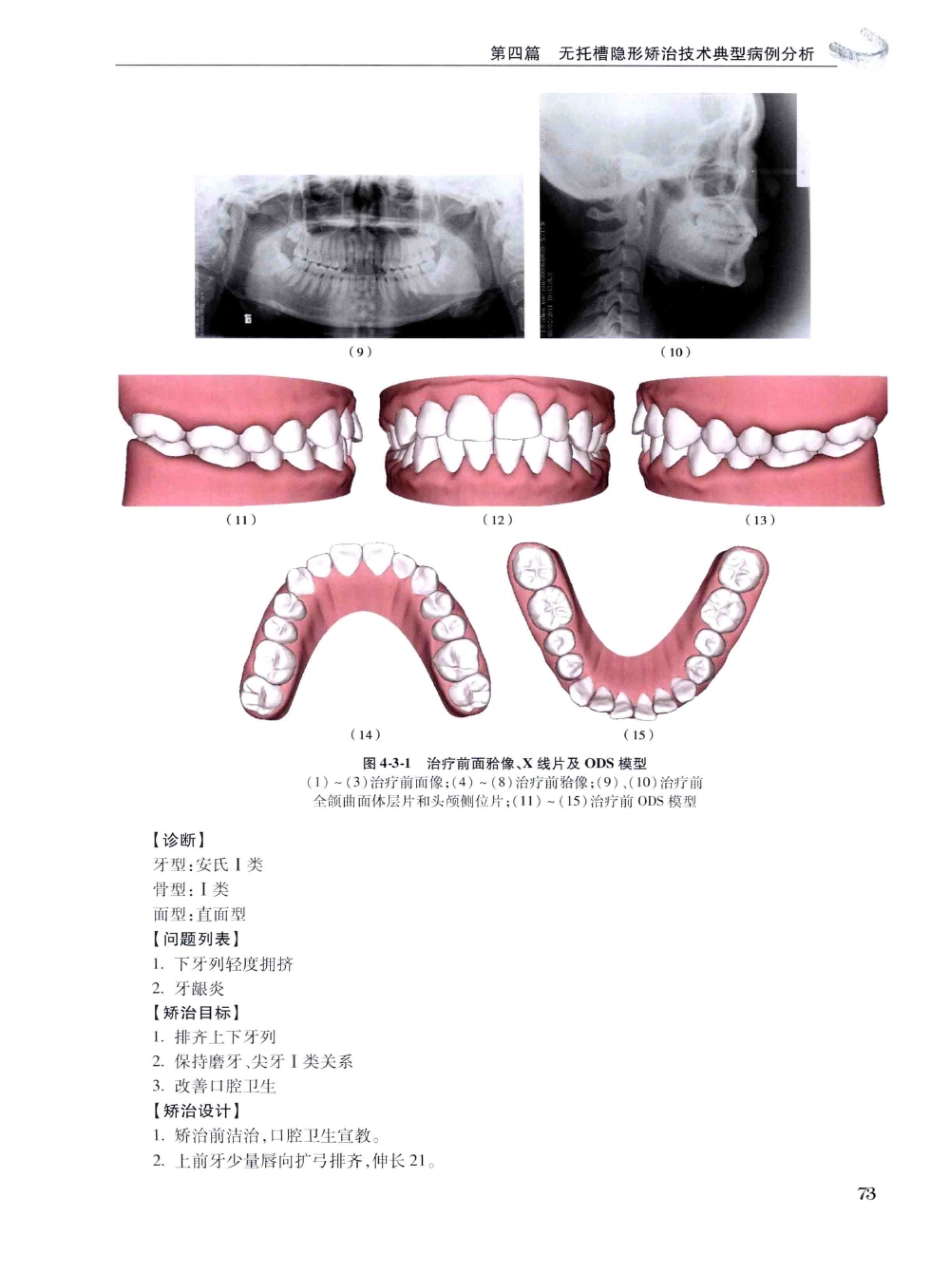 口腔正畸现代无托槽隐形矫治技术 田杰著 2014_85-96.pdf_第3页