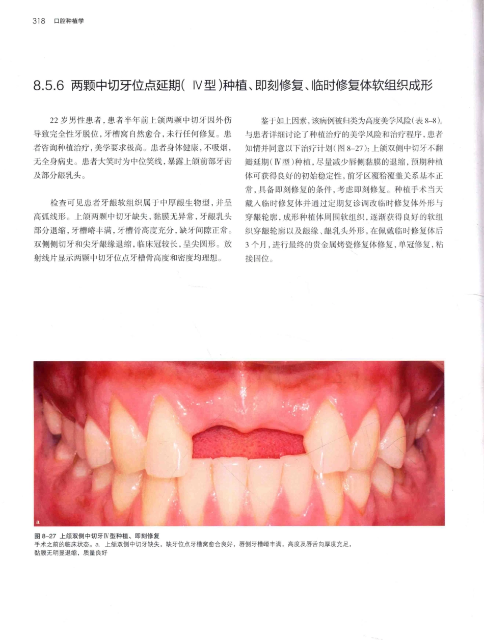 口腔种植学（第2版）_宿玉成主编_2014年（彩图）_361-390.pdf_第1页