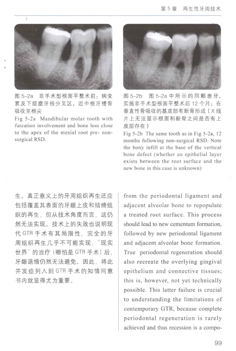 牙周手术临床指南 中英文对照_俞雪芬2013（彩图）_109-120.pdf_第1页