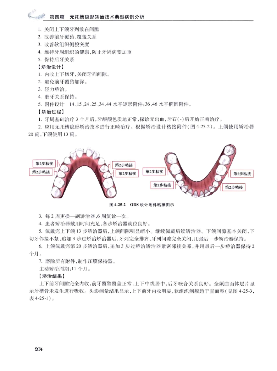 口腔正畸现代无托槽隐形矫治技术 田杰著 2014_217-228.pdf_第2页