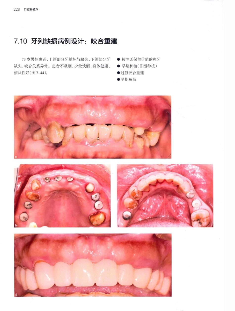 口腔种植学（第2版）_宿玉成主编_2014年（彩图）_271-300.pdf_第1页