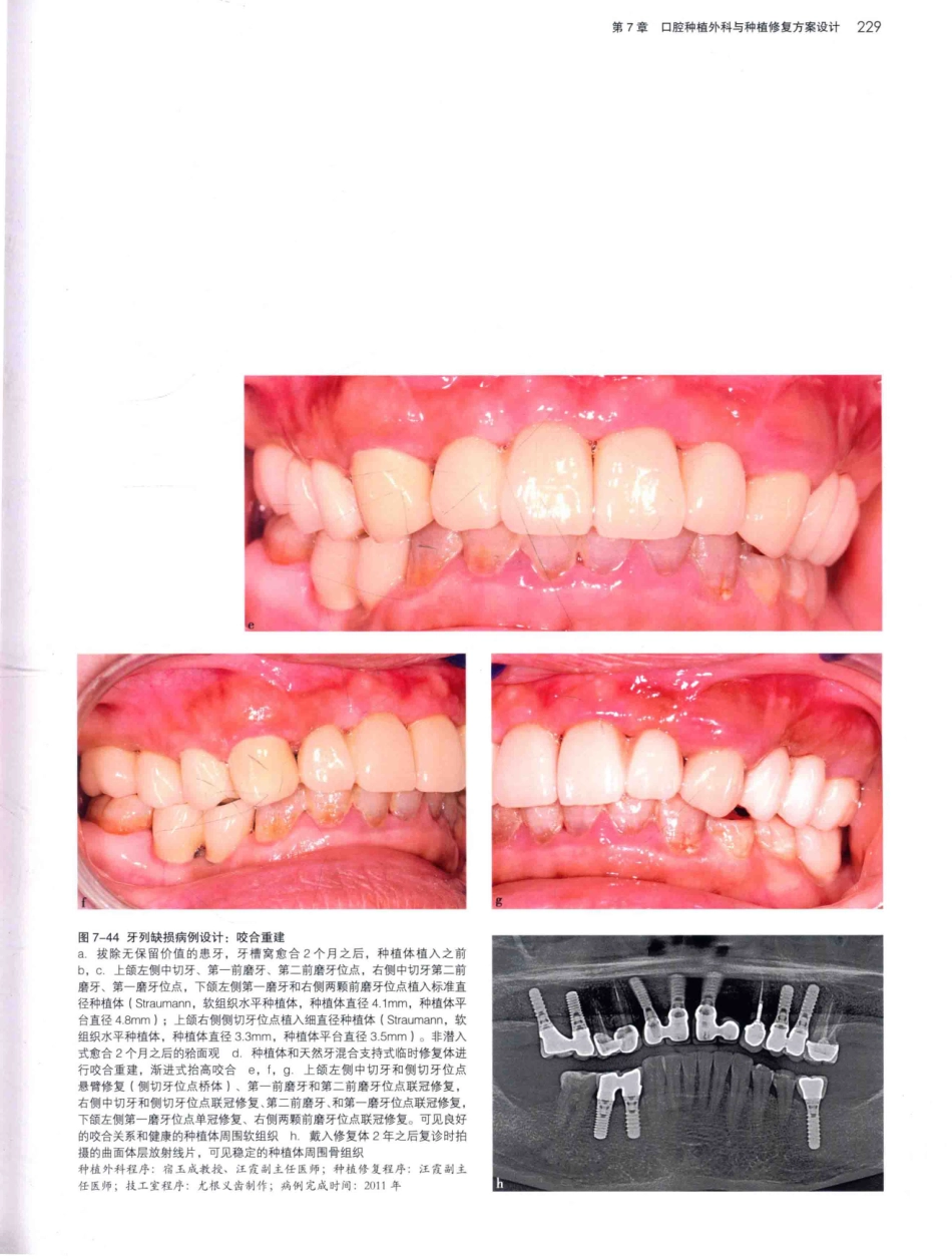 口腔种植学（第2版）_宿玉成主编_2014年（彩图）_271-300.pdf_第2页