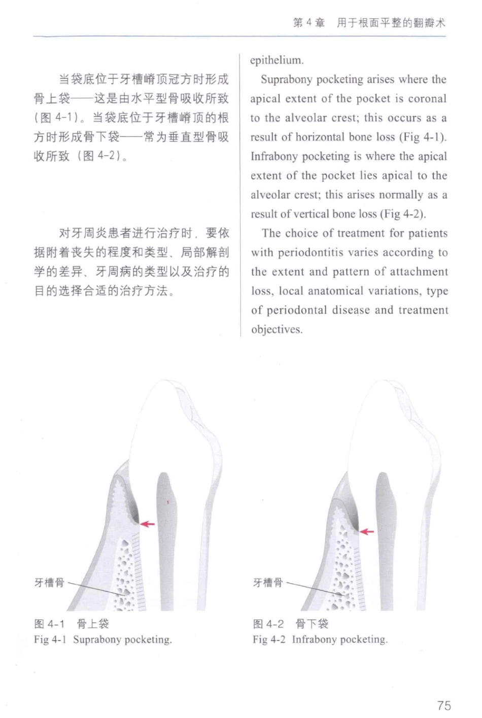 牙周手术临床指南 中英文对照_俞雪芬2013（彩图）_85-96.pdf_第1页