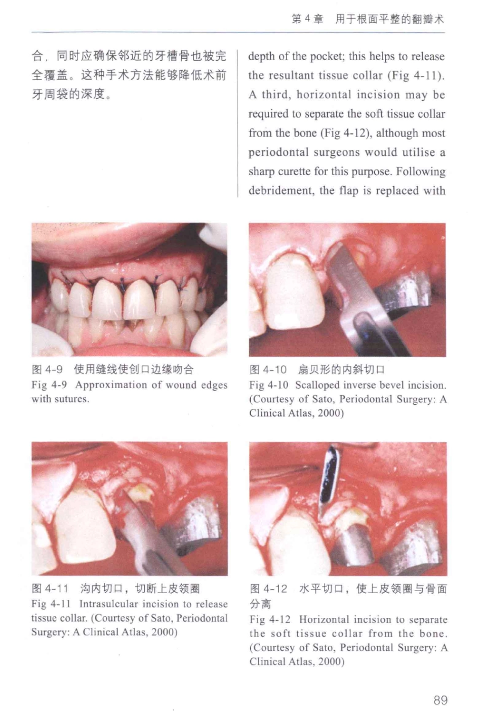 牙周手术临床指南 中英文对照_俞雪芬2013（彩图）_97-108.pdf_第3页