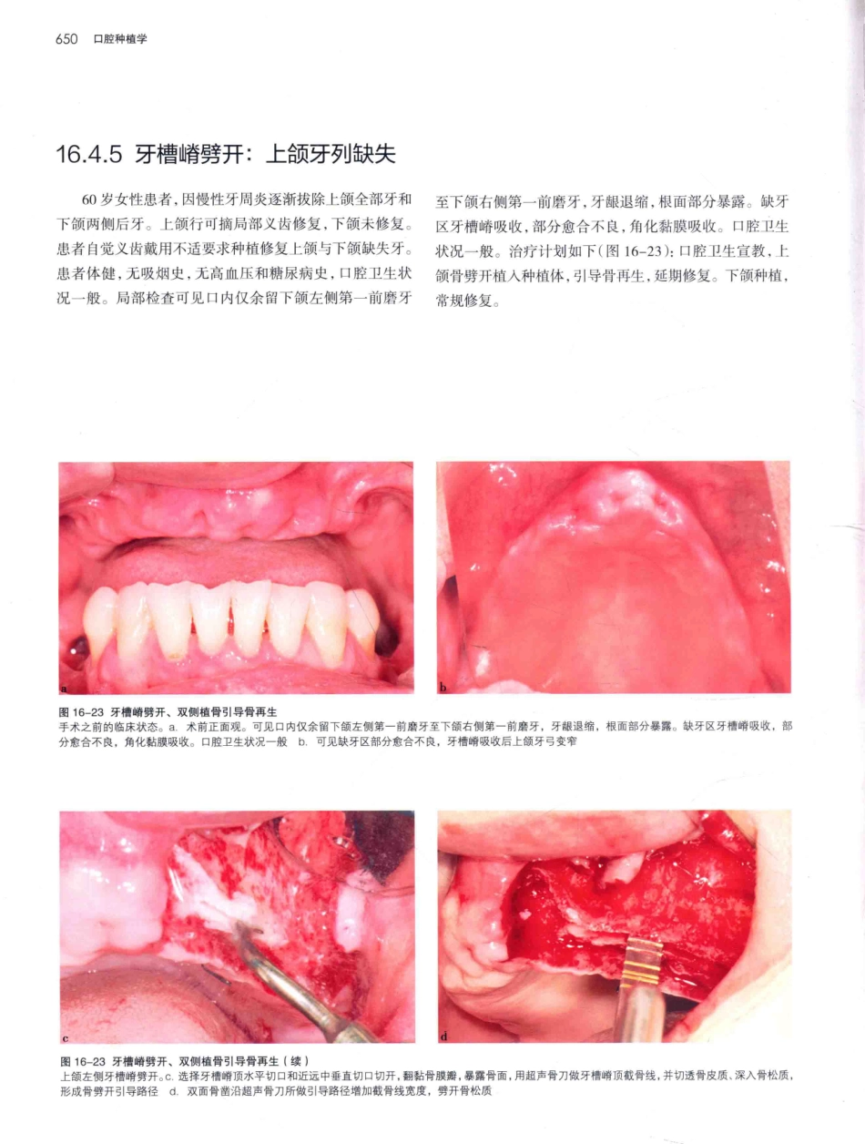 口腔种植学（第2版）_宿玉成主编_2014年（彩图）_691-720.pdf_第3页