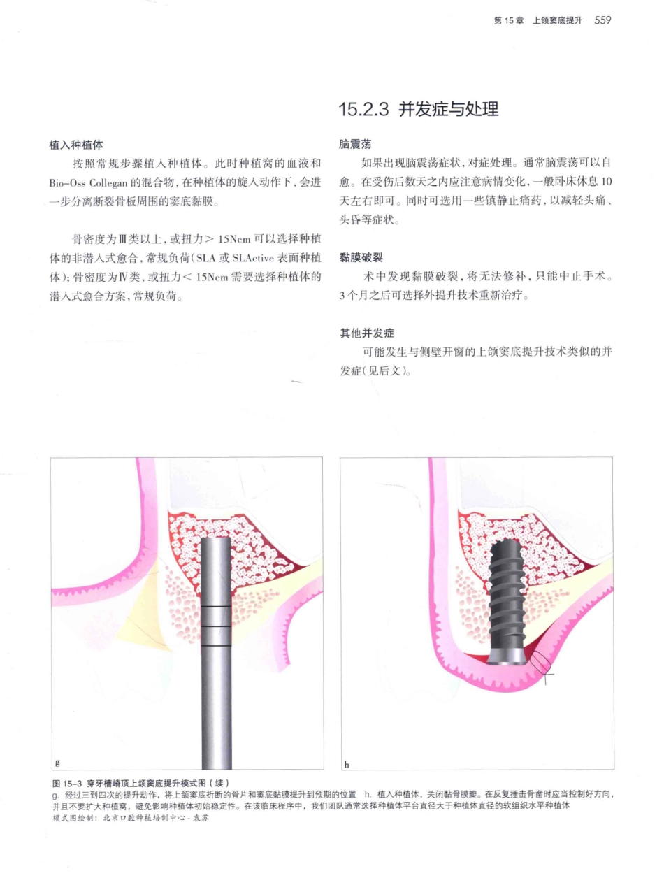 口腔种植学（第2版）_宿玉成主编_2014年（彩图）_601-630.pdf_第2页