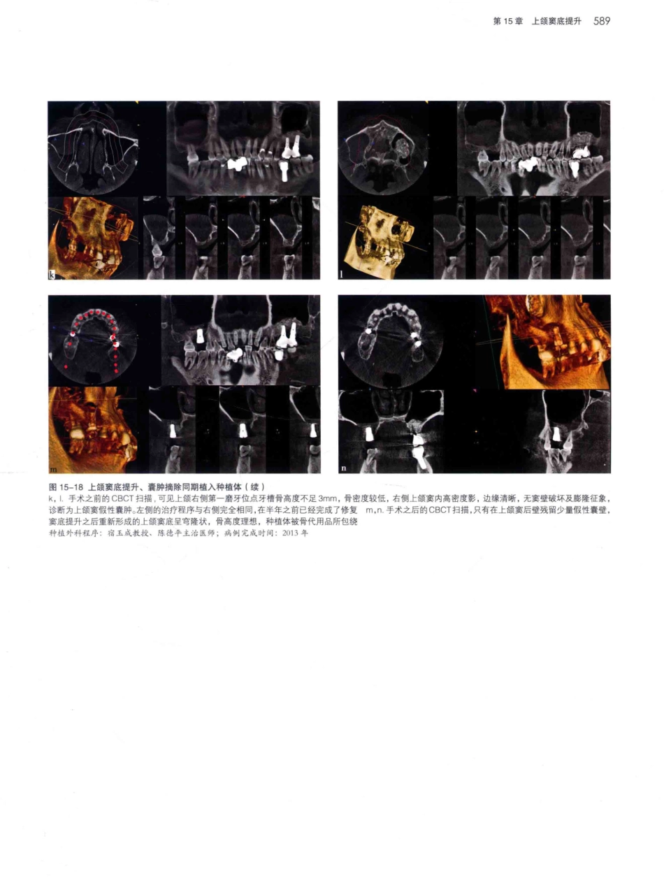 口腔种植学（第2版）_宿玉成主编_2014年（彩图）_631-660.pdf_第2页