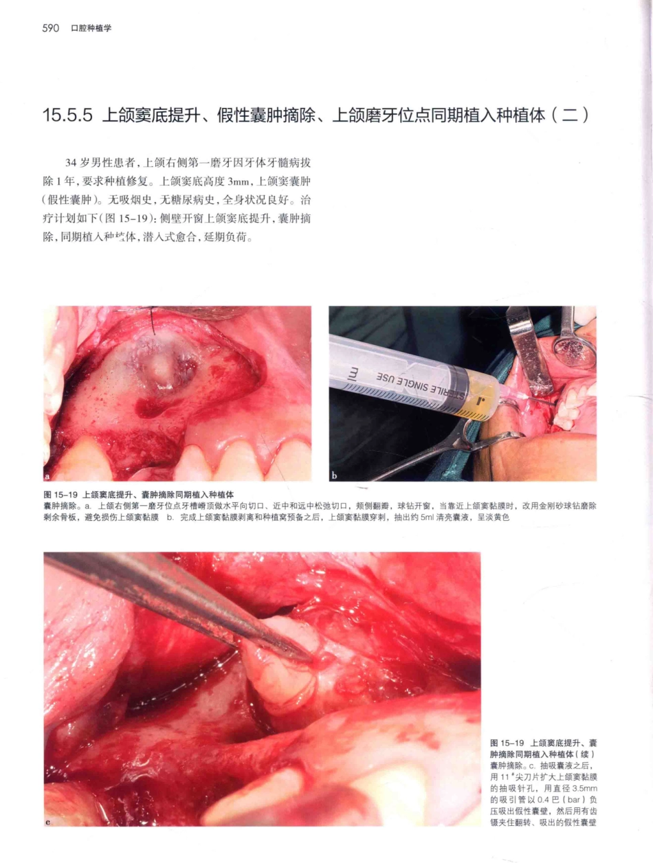 口腔种植学（第2版）_宿玉成主编_2014年（彩图）_631-660.pdf_第3页