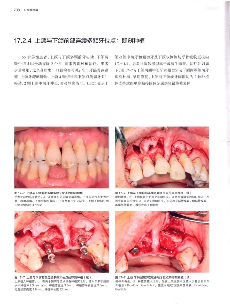口腔种植学（第2版）_宿玉成主编_2014年（彩图）_751-780.pdf_第1页