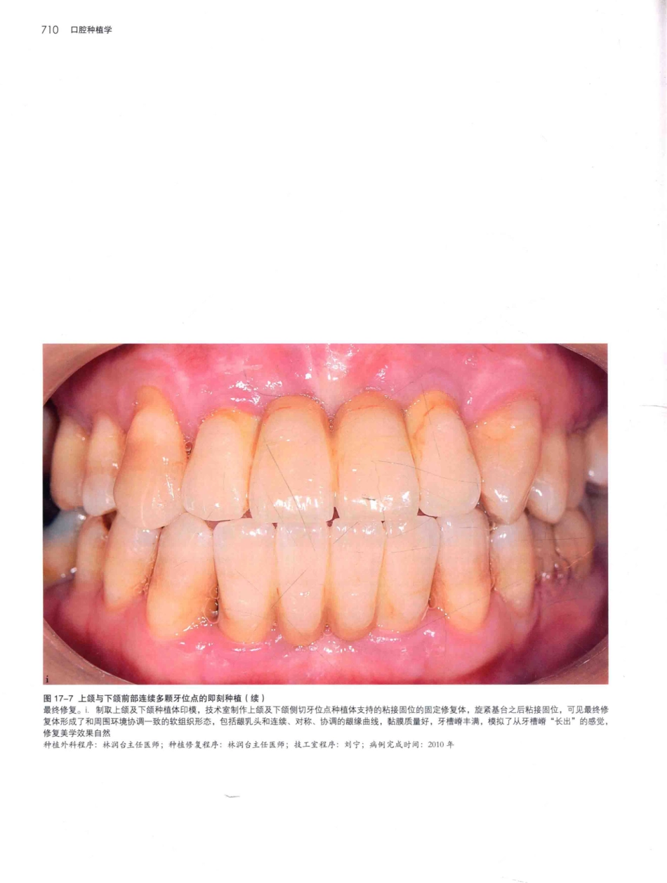 口腔种植学（第2版）_宿玉成主编_2014年（彩图）_751-780.pdf_第3页