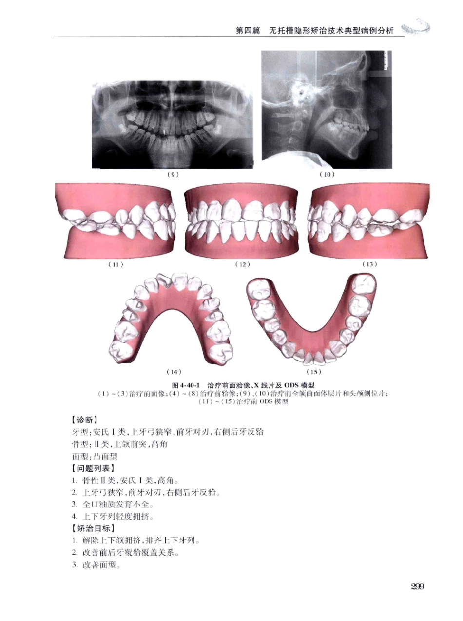 口腔正畸现代无托槽隐形矫治技术 田杰著 2014_313-322.pdf_第1页