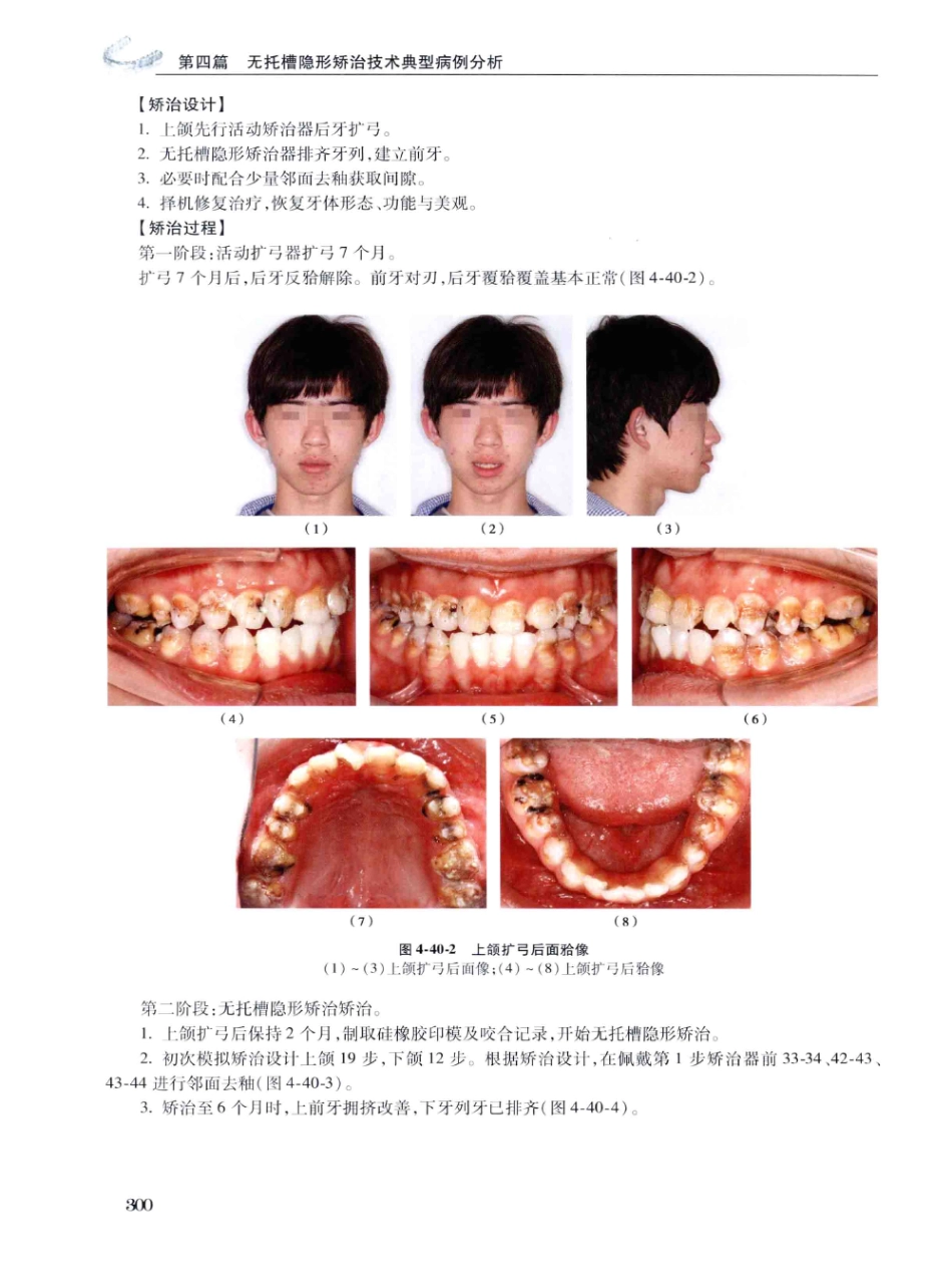 口腔正畸现代无托槽隐形矫治技术 田杰著 2014_313-322.pdf_第2页