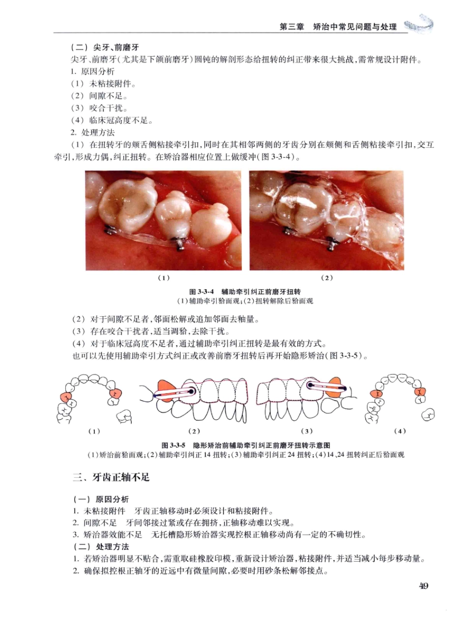 口腔正畸现代无托槽隐形矫治技术 田杰著 2014_61-72.pdf_第3页