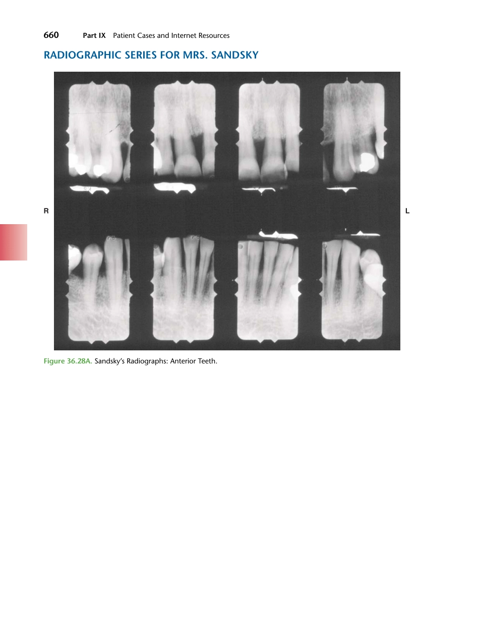 牙周2012Foundations of Periodontics for the Dental Hygienist _676-700.pdf_第3页