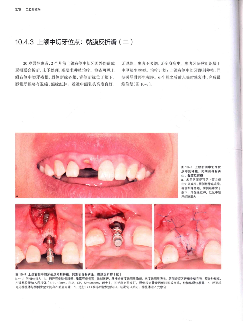 口腔种植学（第2版）_宿玉成主编_2014年（彩图）_421-450.pdf_第1页