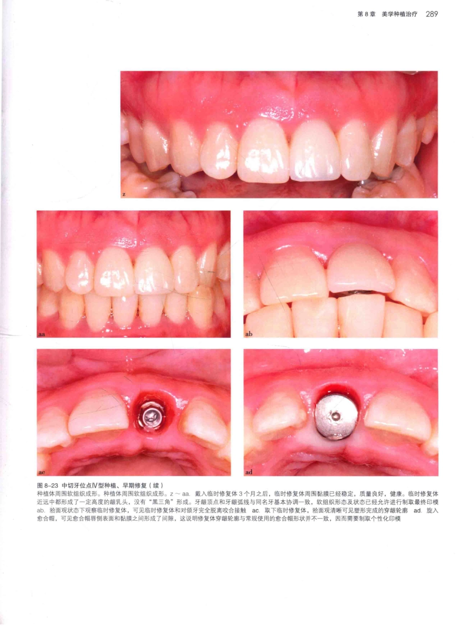 口腔种植学（第2版）_宿玉成主编_2014年（彩图）_331-360.pdf_第2页