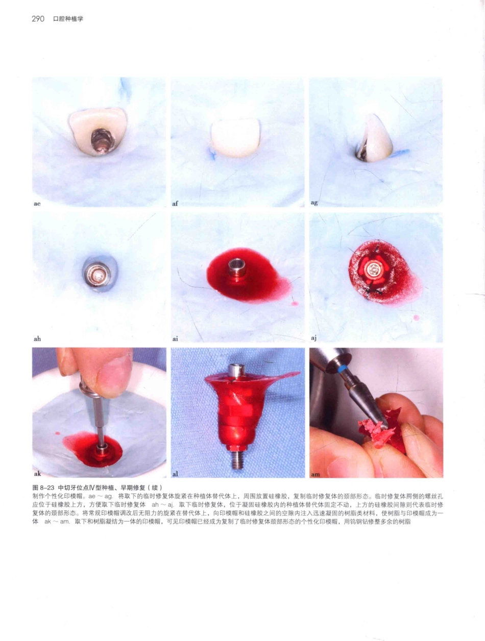 口腔种植学（第2版）_宿玉成主编_2014年（彩图）_331-360.pdf_第3页