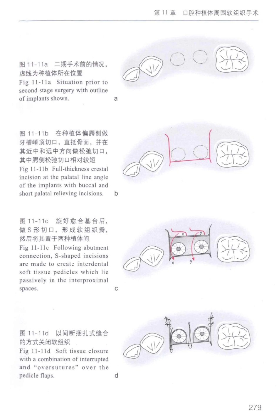 牙周手术临床指南 中英文对照_俞雪芬2013（彩图）_289-291.pdf_第1页