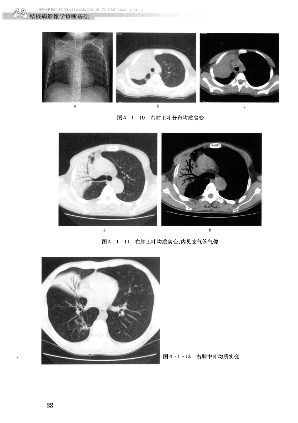 结核病影像学基础_13071936_31-60.pdf_第2页