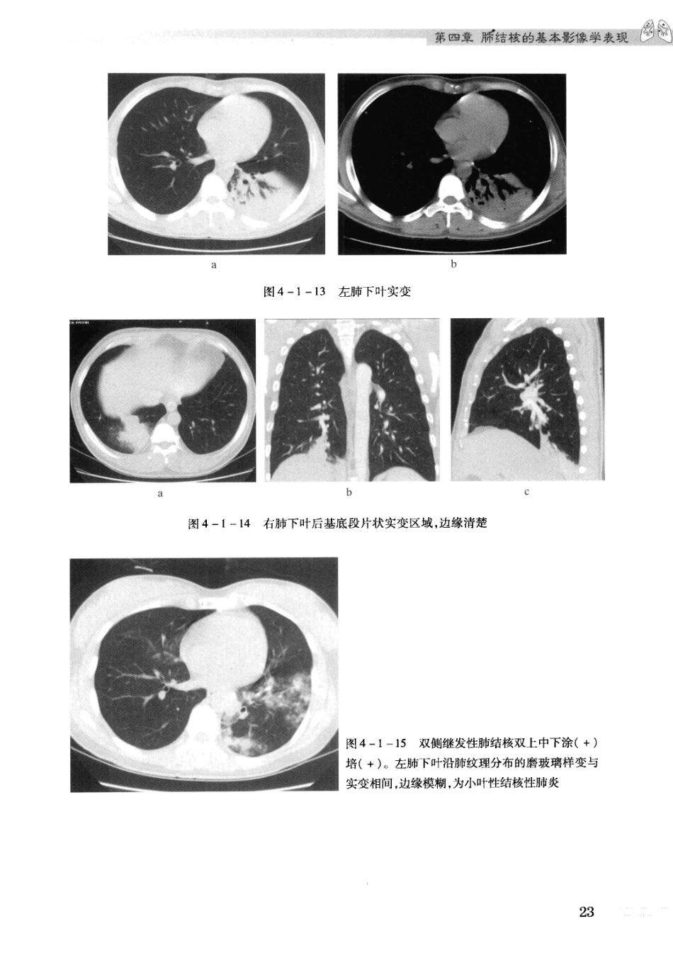 结核病影像学基础_13071936_31-60.pdf_第3页