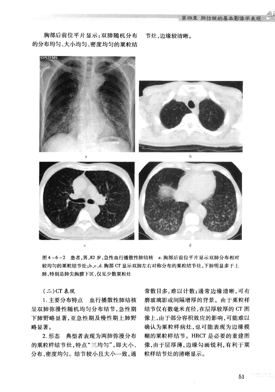 结核病影像学基础_13071936_61-90.pdf_第1页
