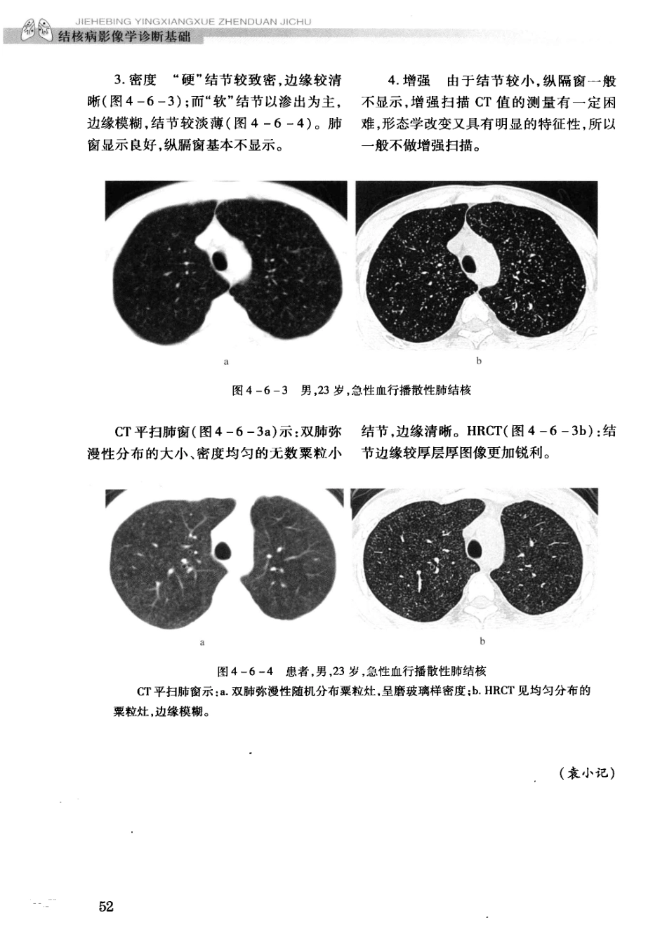 结核病影像学基础_13071936_61-90.pdf_第2页