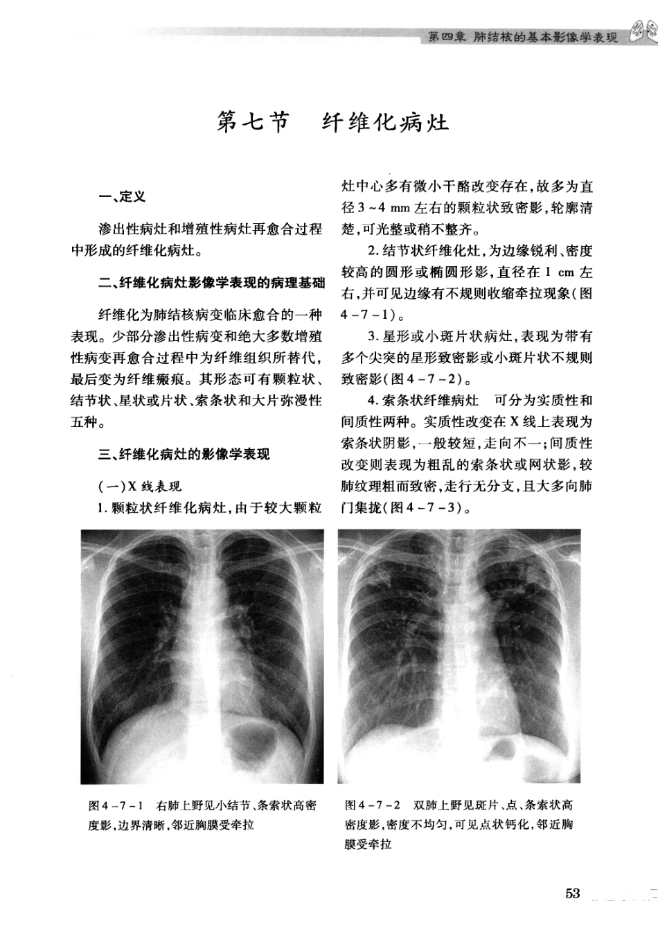 结核病影像学基础_13071936_61-90.pdf_第3页