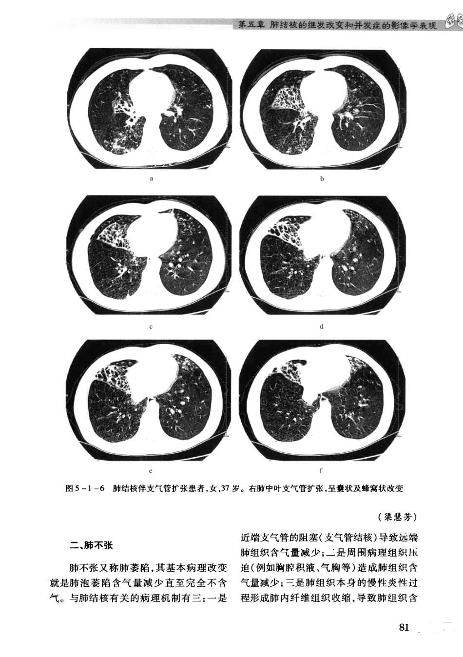 结核病影像学基础_13071936_91-120.pdf_第1页
