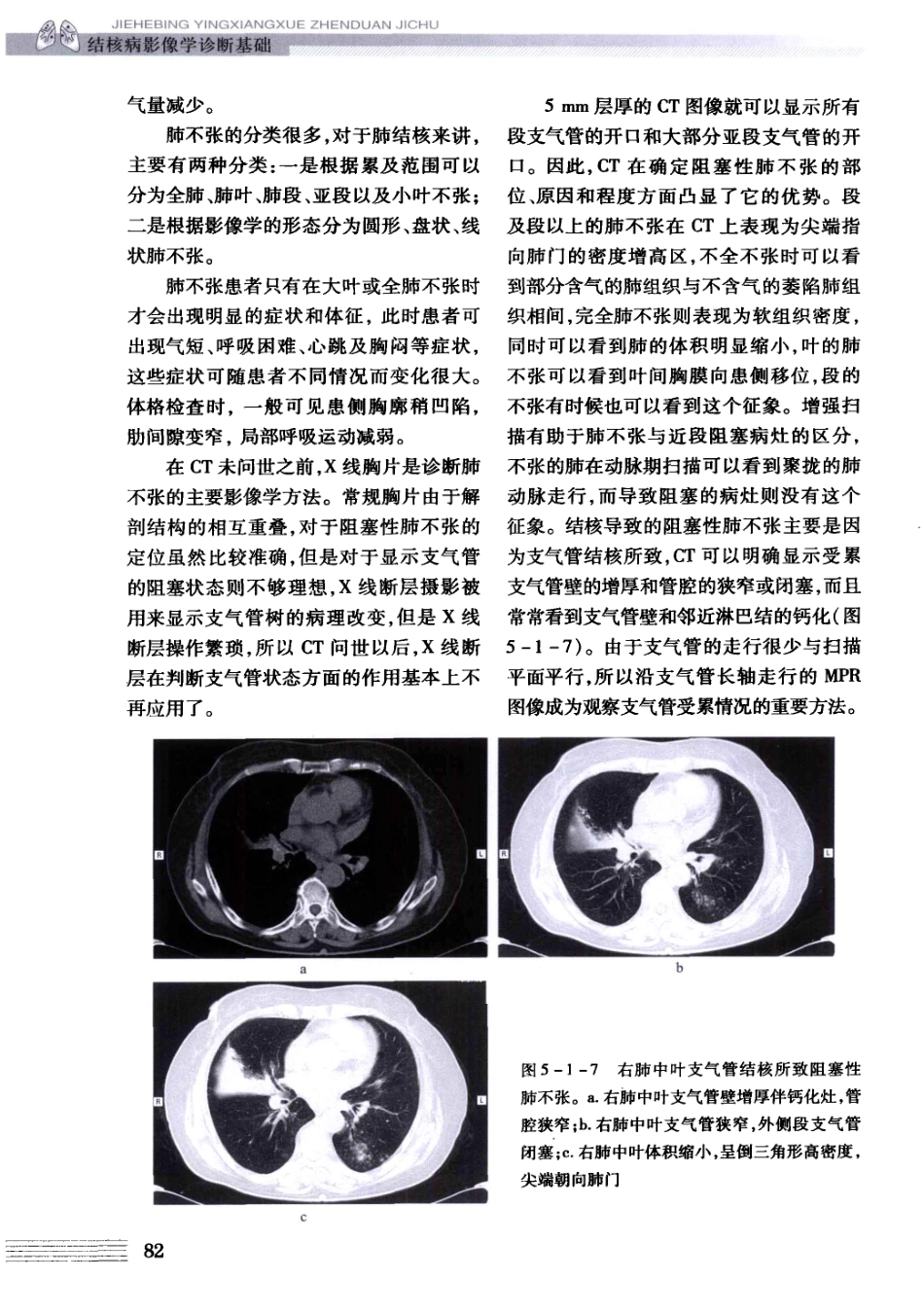 结核病影像学基础_13071936_91-120.pdf_第2页