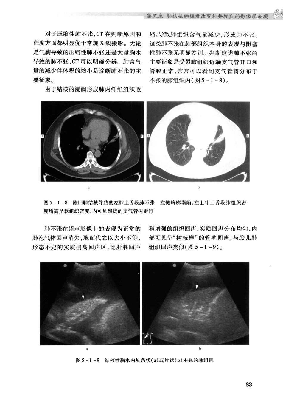 结核病影像学基础_13071936_91-120.pdf_第3页