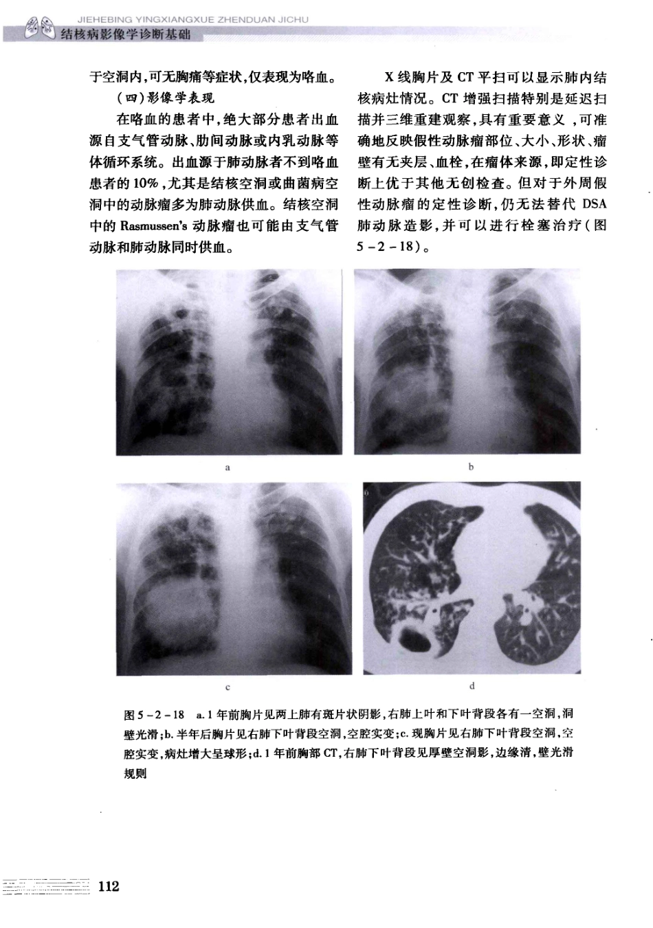 结核病影像学基础_13071936_121-150.pdf_第2页