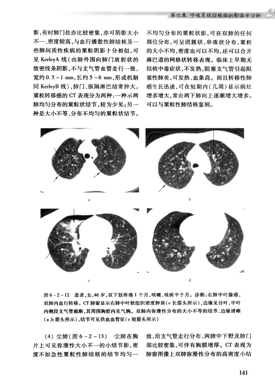 结核病影像学基础_13071936_151-180.pdf_第1页