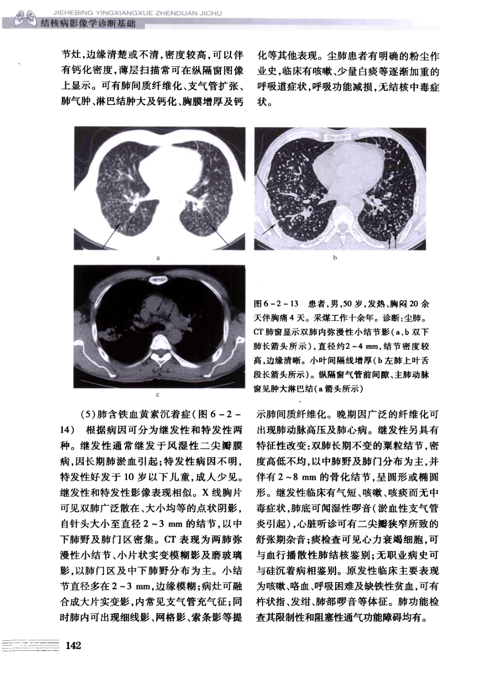 结核病影像学基础_13071936_151-180.pdf_第2页