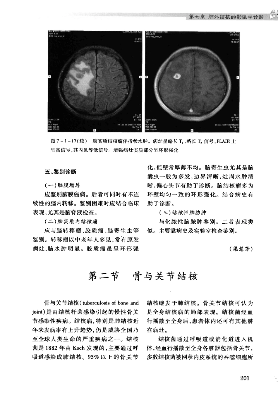 结核病影像学基础_13071936_211-240.pdf_第1页