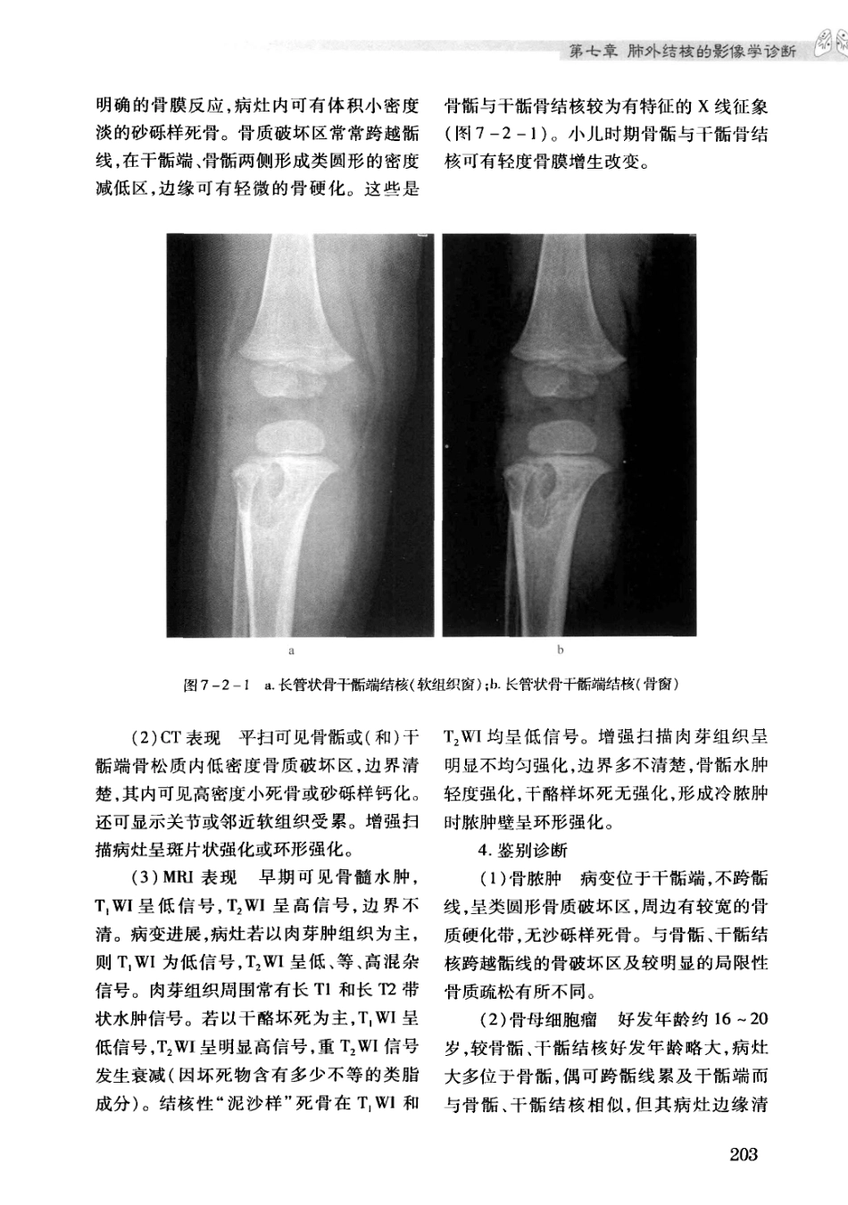 结核病影像学基础_13071936_211-240.pdf_第3页