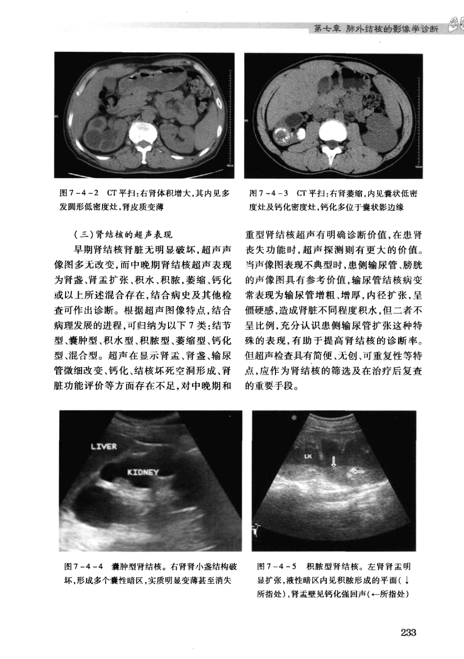 结核病影像学基础_13071936_241-270.pdf_第3页