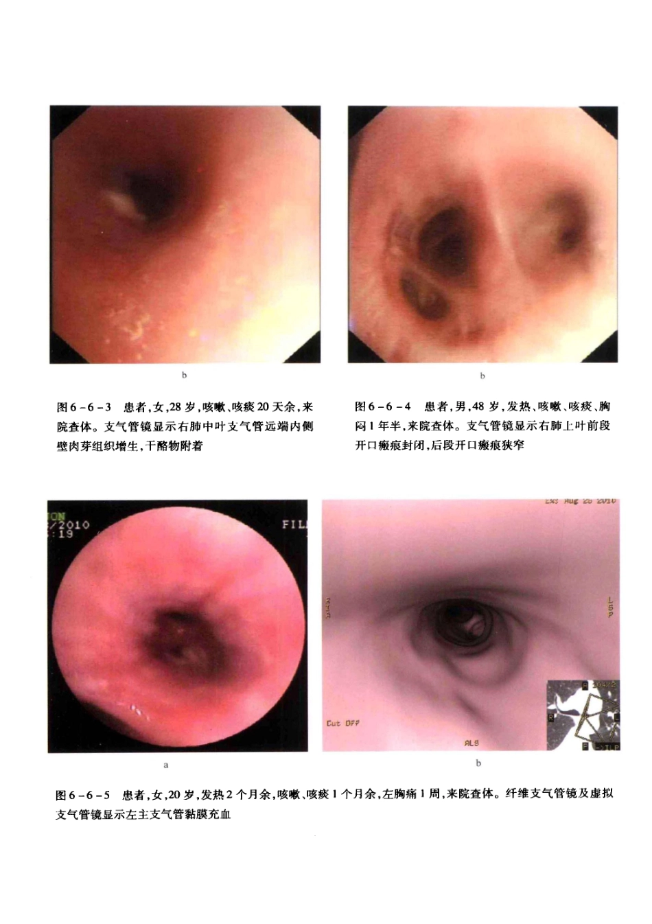 结核病影像学基础_13071936_271-280.pdf_第2页