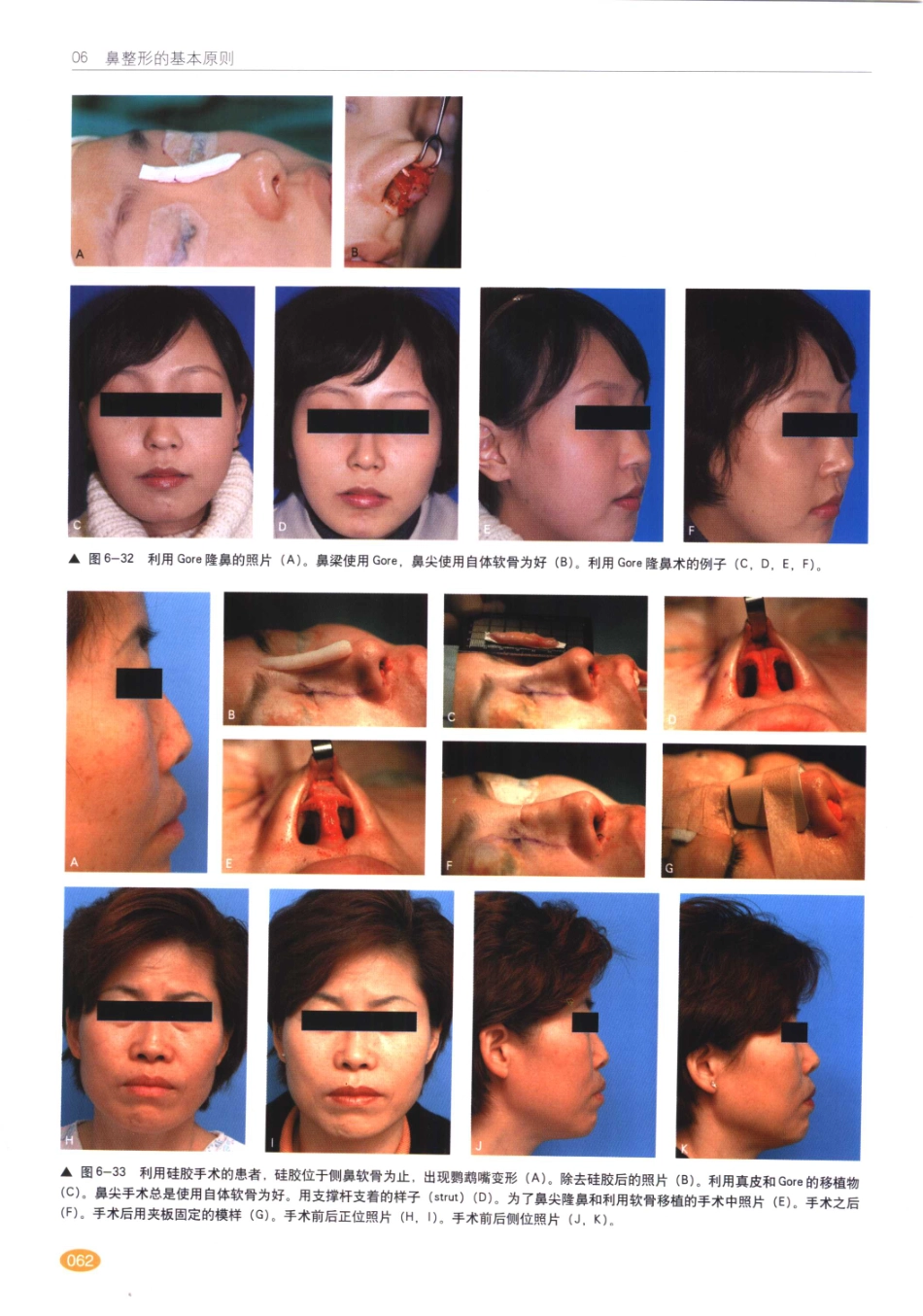 现代韩国鼻整形术_61-80.pdf_第3页