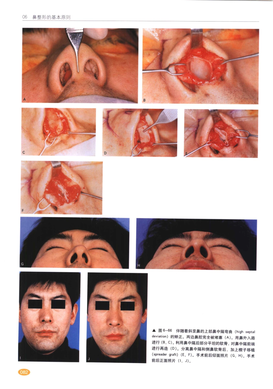 现代韩国鼻整形术_81-100.pdf_第3页