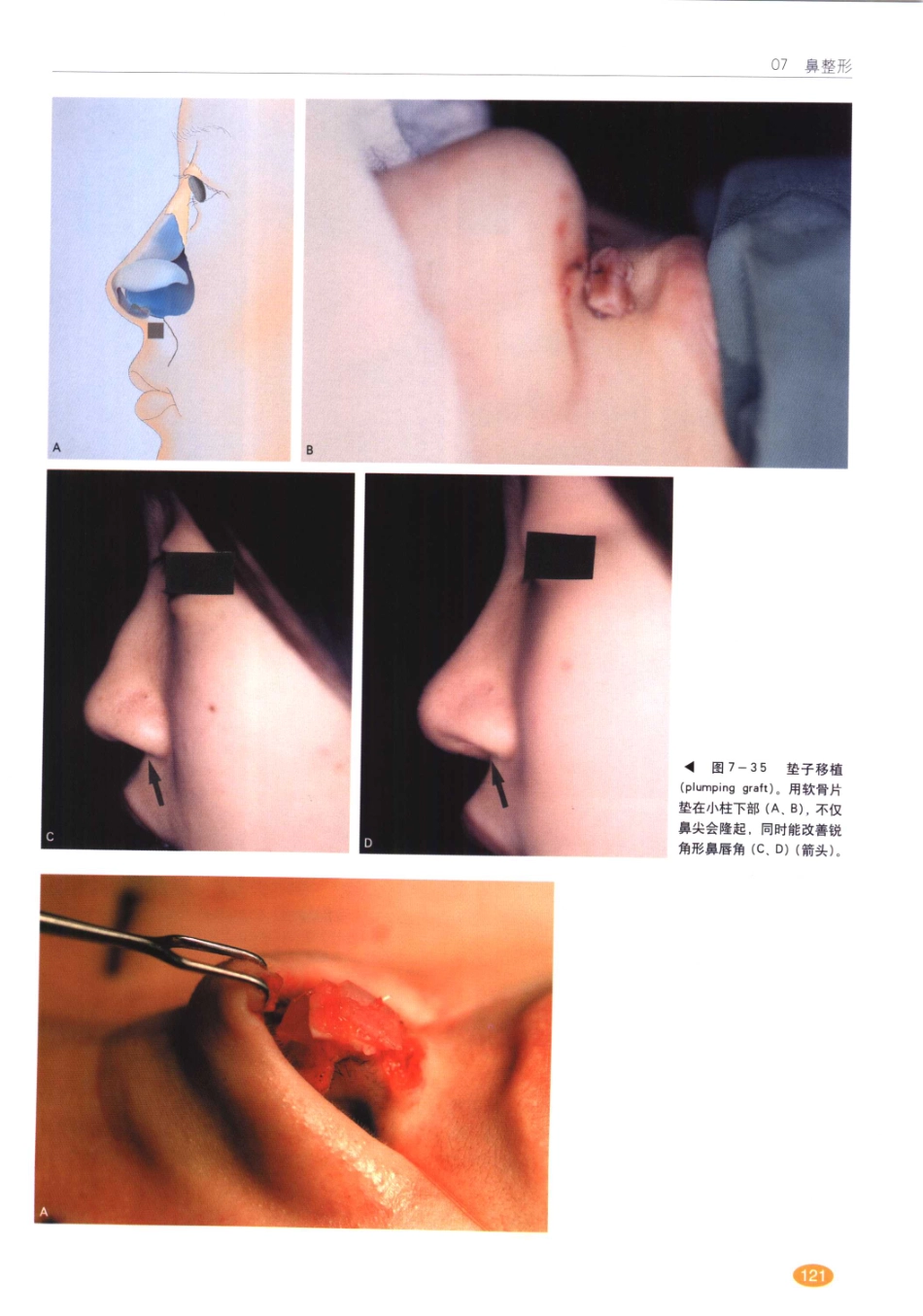 现代韩国鼻整形术_121-140.pdf_第2页
