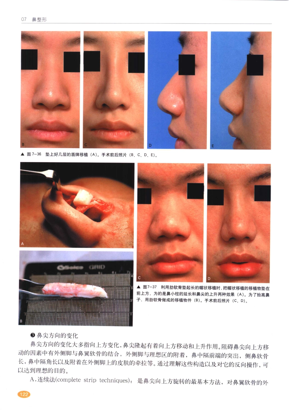 现代韩国鼻整形术_121-140.pdf_第3页